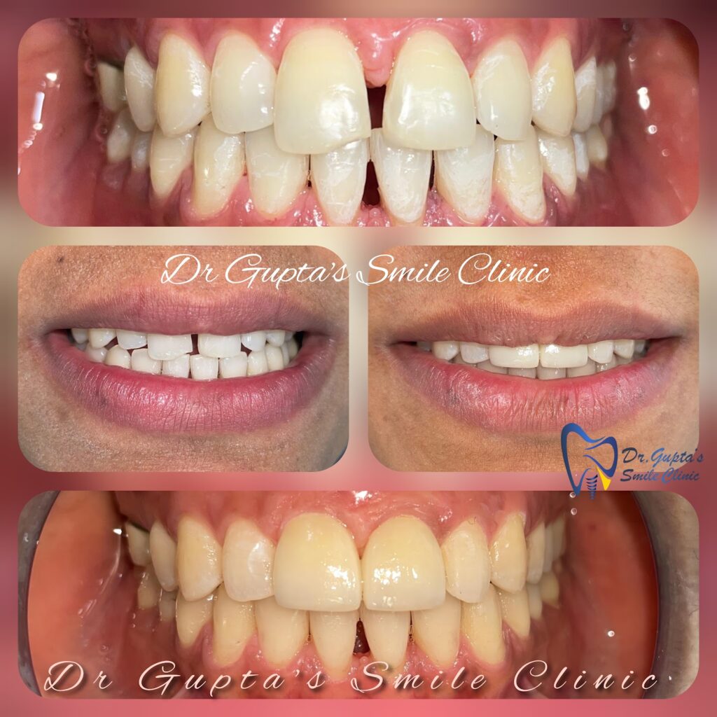 Veneers before and after comparison at Dr. Gupta's Smile Clinic