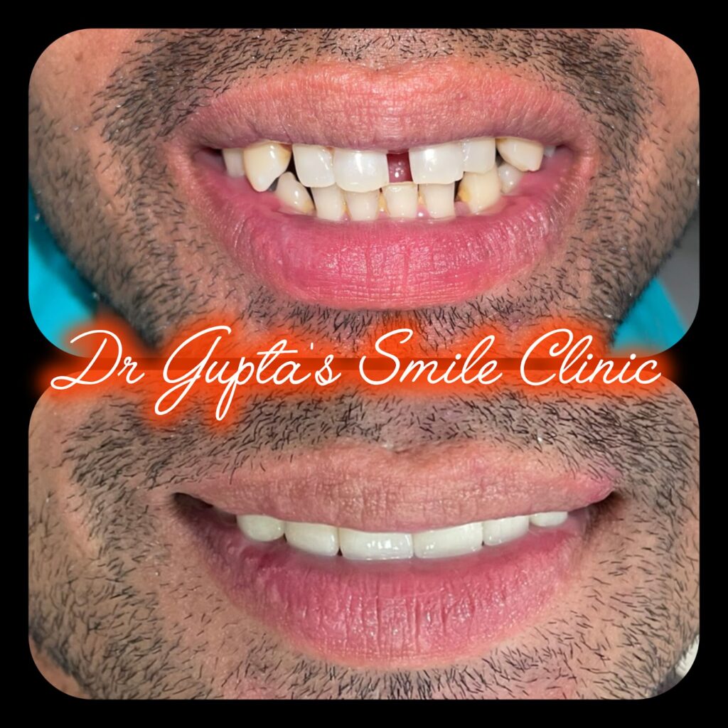 Front teeth veneers result at Dr. Gupta's Smile Clinic, Zirakpur